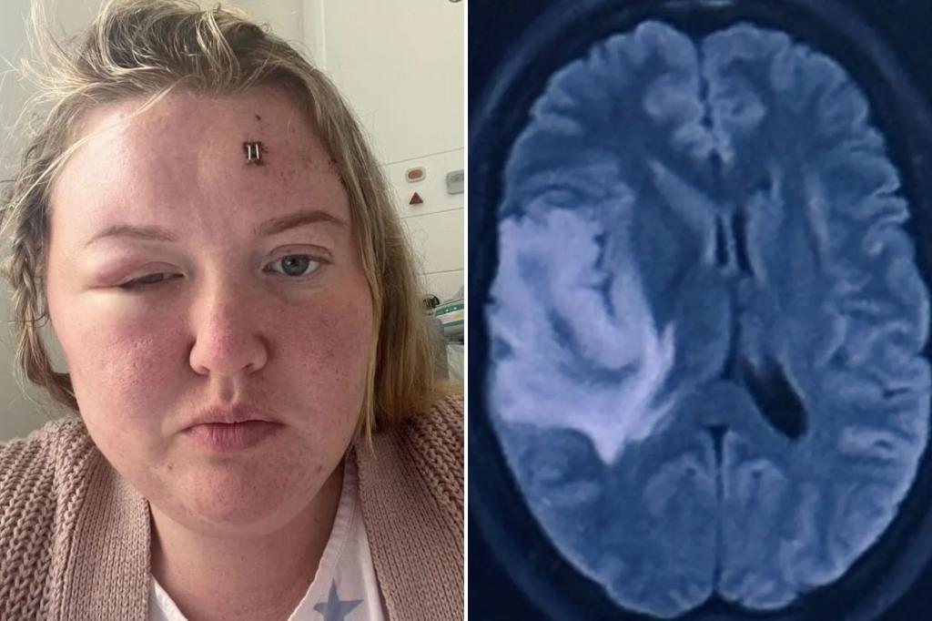 My week long headache turned out to be a brain tumor - I had an unusual sign